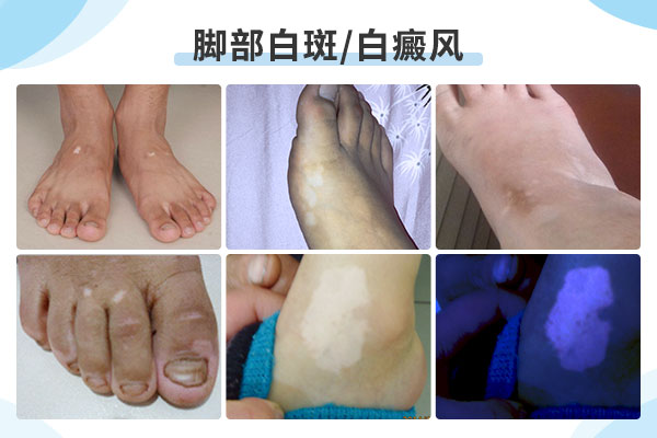 病人脚部有白癜风怎么办呢?