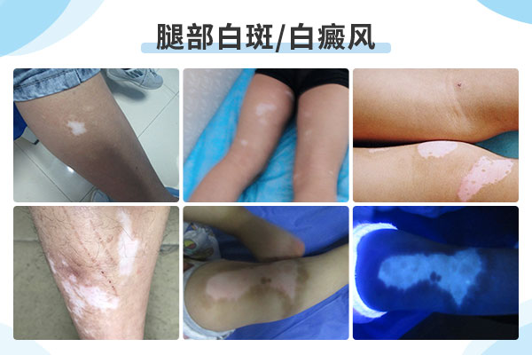 腿上长了很多白癜风该怎么办才好?