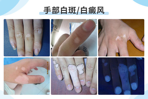 为什么手上会出现白癜风?