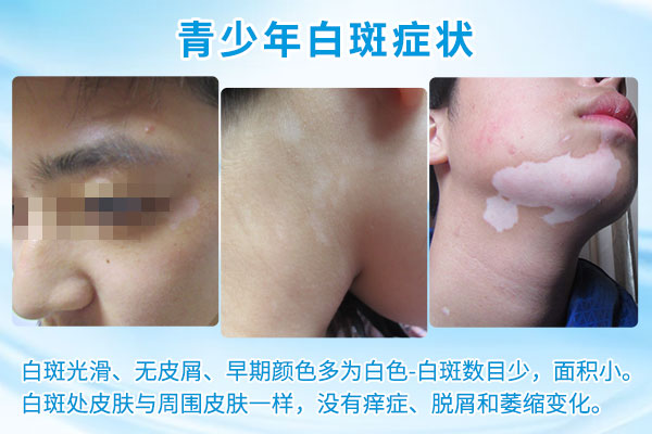 青少年要怎么注意预防白癜风?