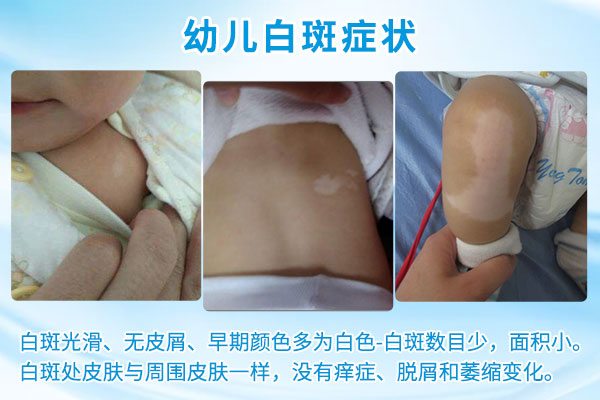 婴幼儿白癜风有什么症状呢?