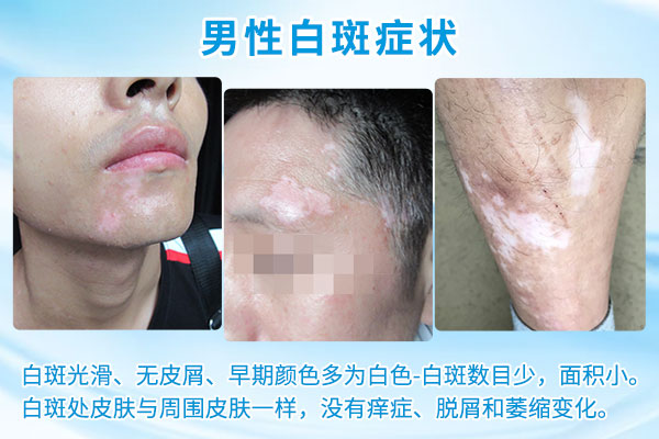 哪些是白癜风的高发人群?