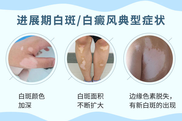 白癜风的白斑扩散对病人有什么影响?
