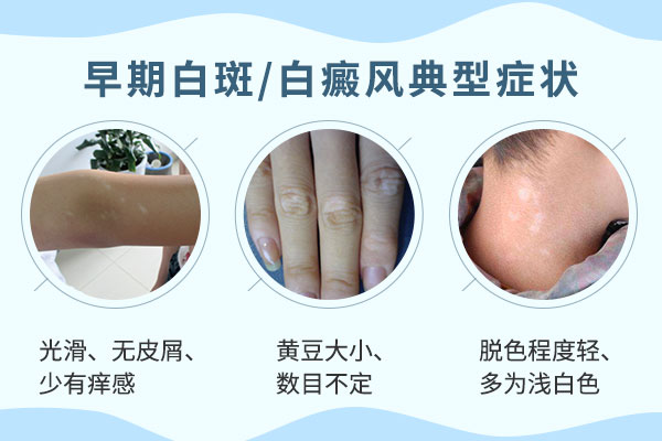 白癜风的初期症状都有哪些呢?