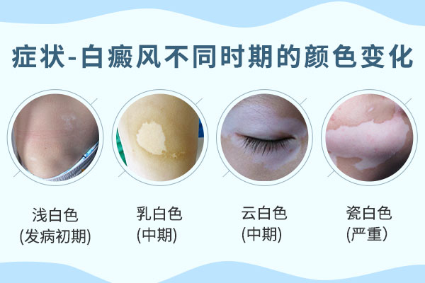 白癜风的症状该如何区分呢?